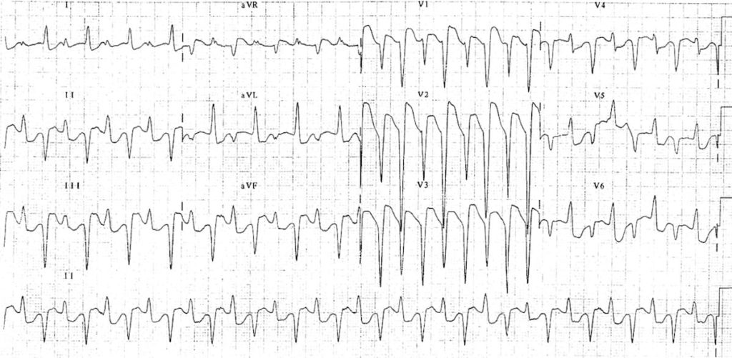ECG Bidirectional Ventricular Tachycardia 2