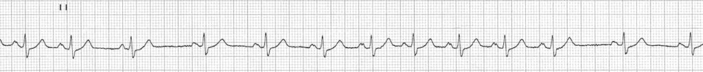 ECG Sinus arrhythmia lead II