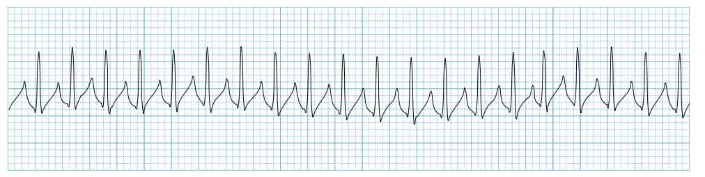 Supraventricular-tachycardia SVT Rhythm Strip