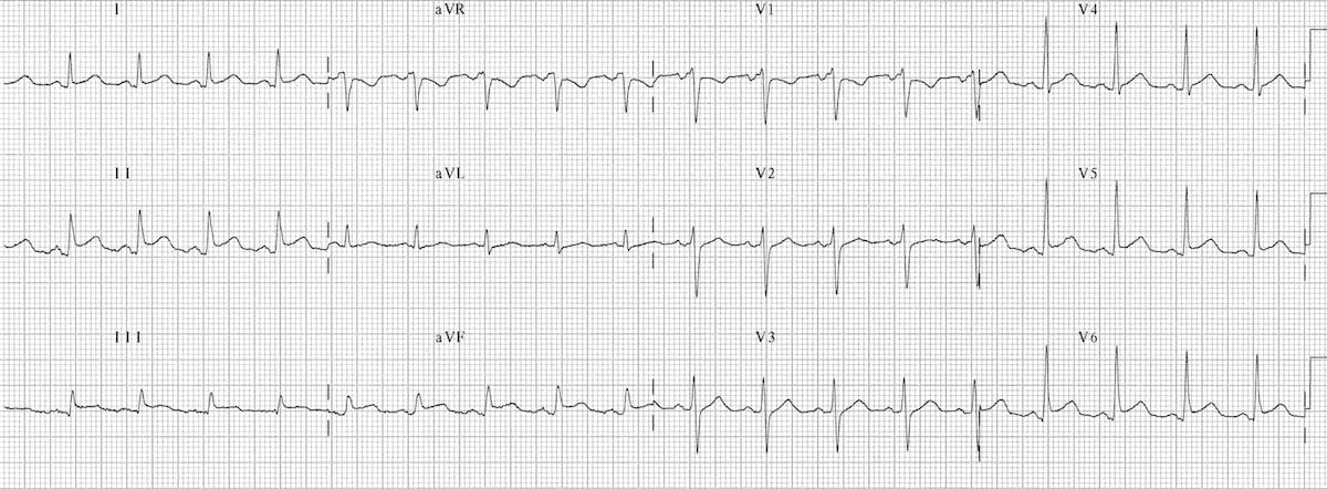 ECG Pericarditis 2