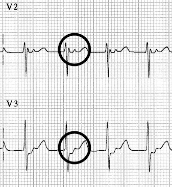 Fast-Slow-AVNRT ECG Retrograde P waves