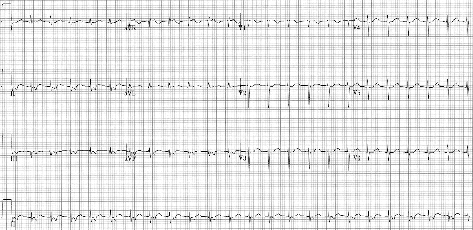 Fast-Slow AVNRT ECG 5