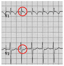 Pseudo R’ waves