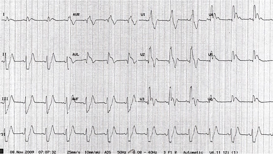 ECG Electrocardiographic Exigency 001