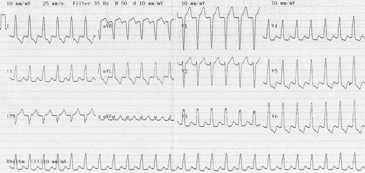 ECG SVT AVNRT LBBB 2
