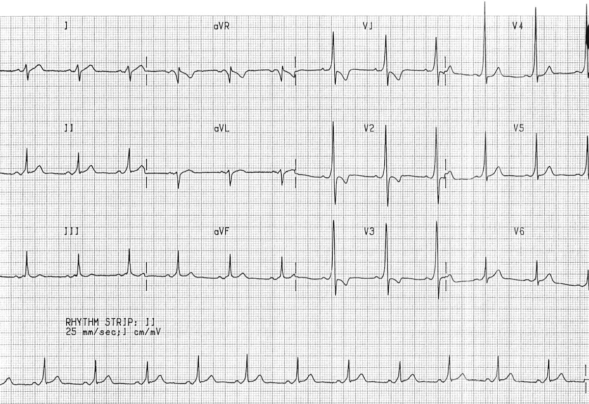 Type A WPW ECG 1