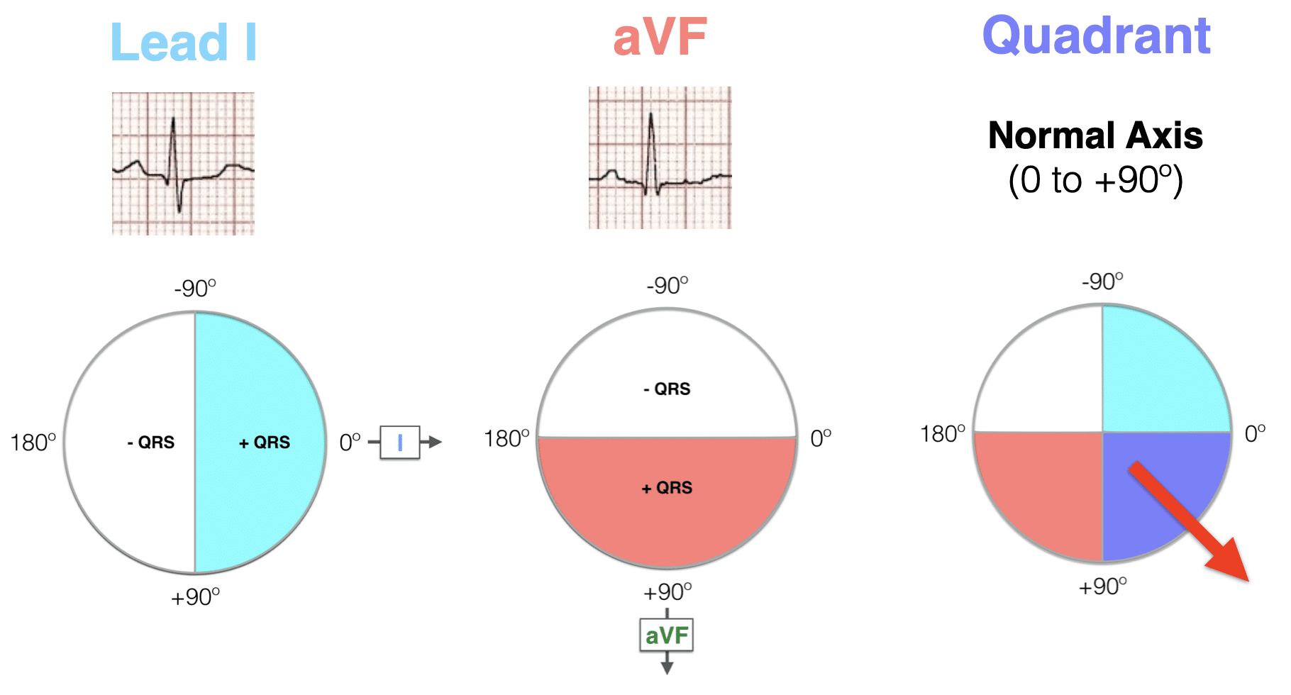 Hexaxial ECG AXIS Quadrant Method Normal axis 2021