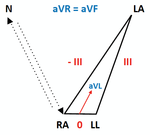 ECG Lead reversal RA-RL diagram
