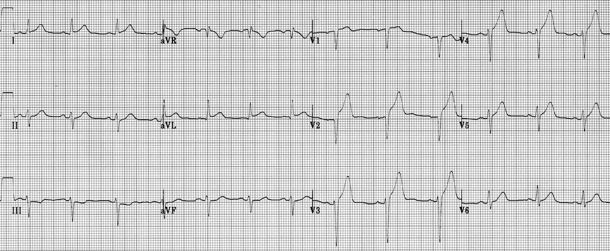 ECG Anterolateral AMI STEMI 2