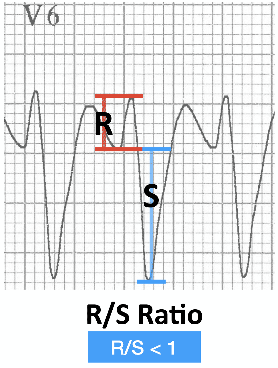 ECG VT V6 R-S ratio RBBB morphology 500