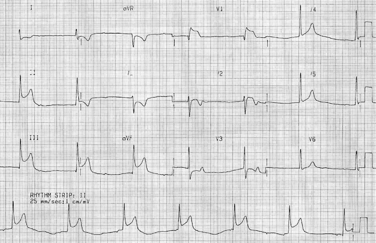 ECG Inferior STEMI with sinus node dysfunction