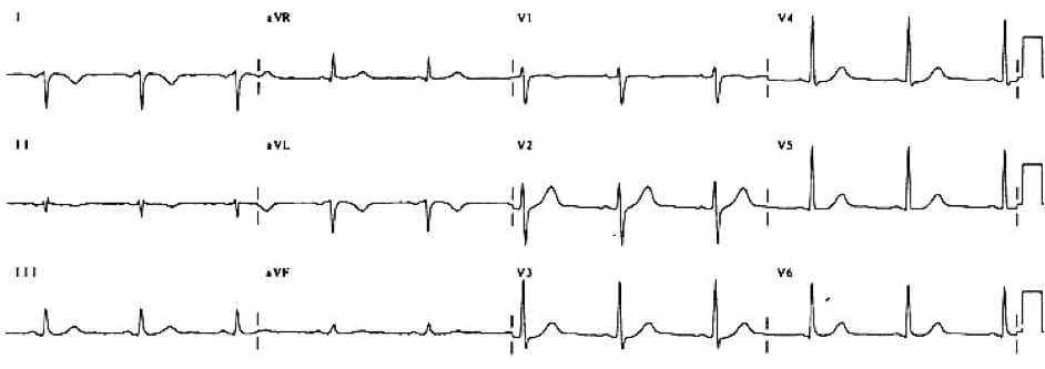 TOP 100 ECG QUIZ LITFL 025
