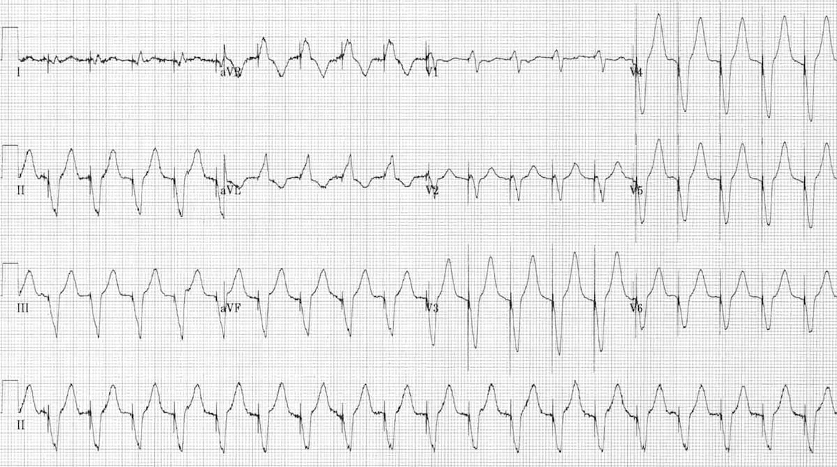 PMT Pacemaker-mediated tachycardia