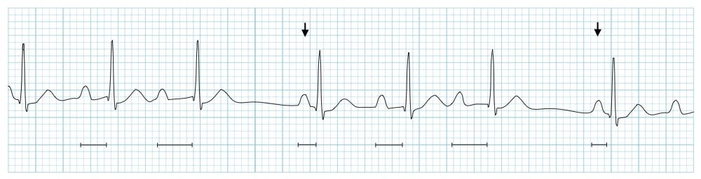 Wenckebach AV block with Wenckebach SA block