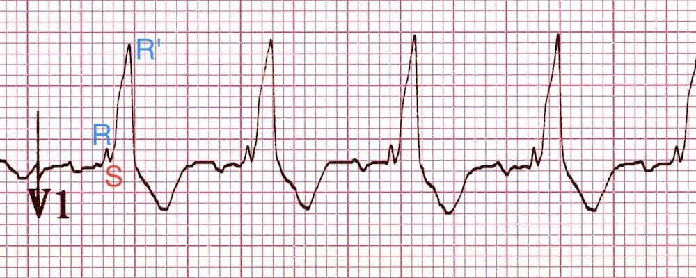 ECG Right Bundle Branch Block RBBB V1 RSR Complex