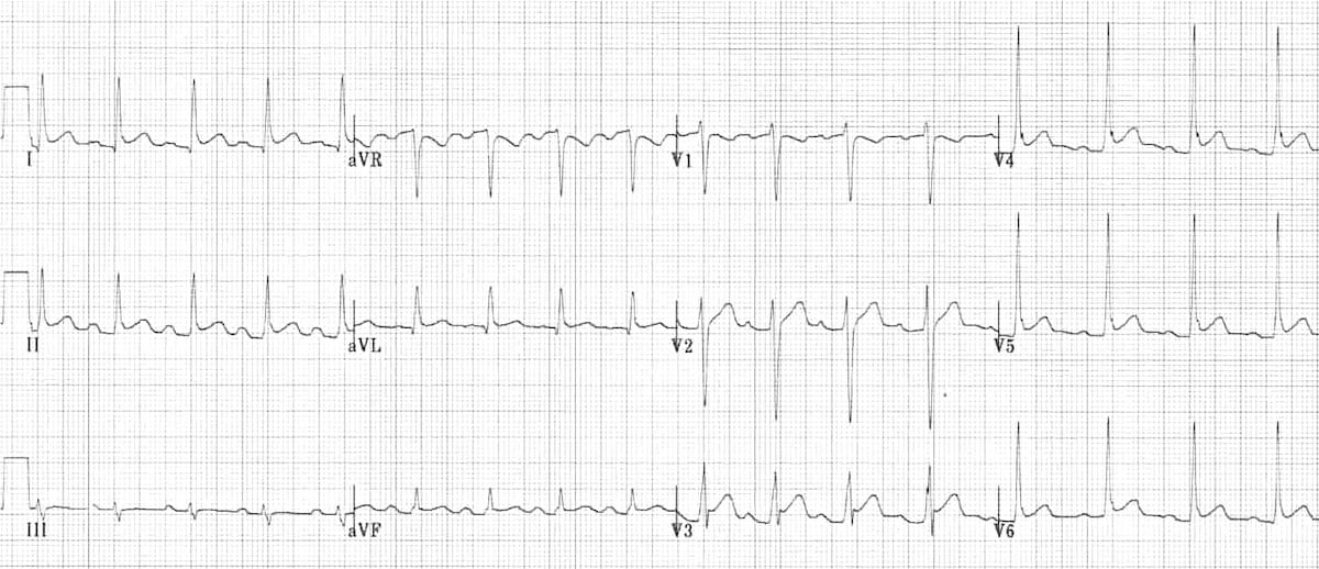 ECG Pericarditis 3