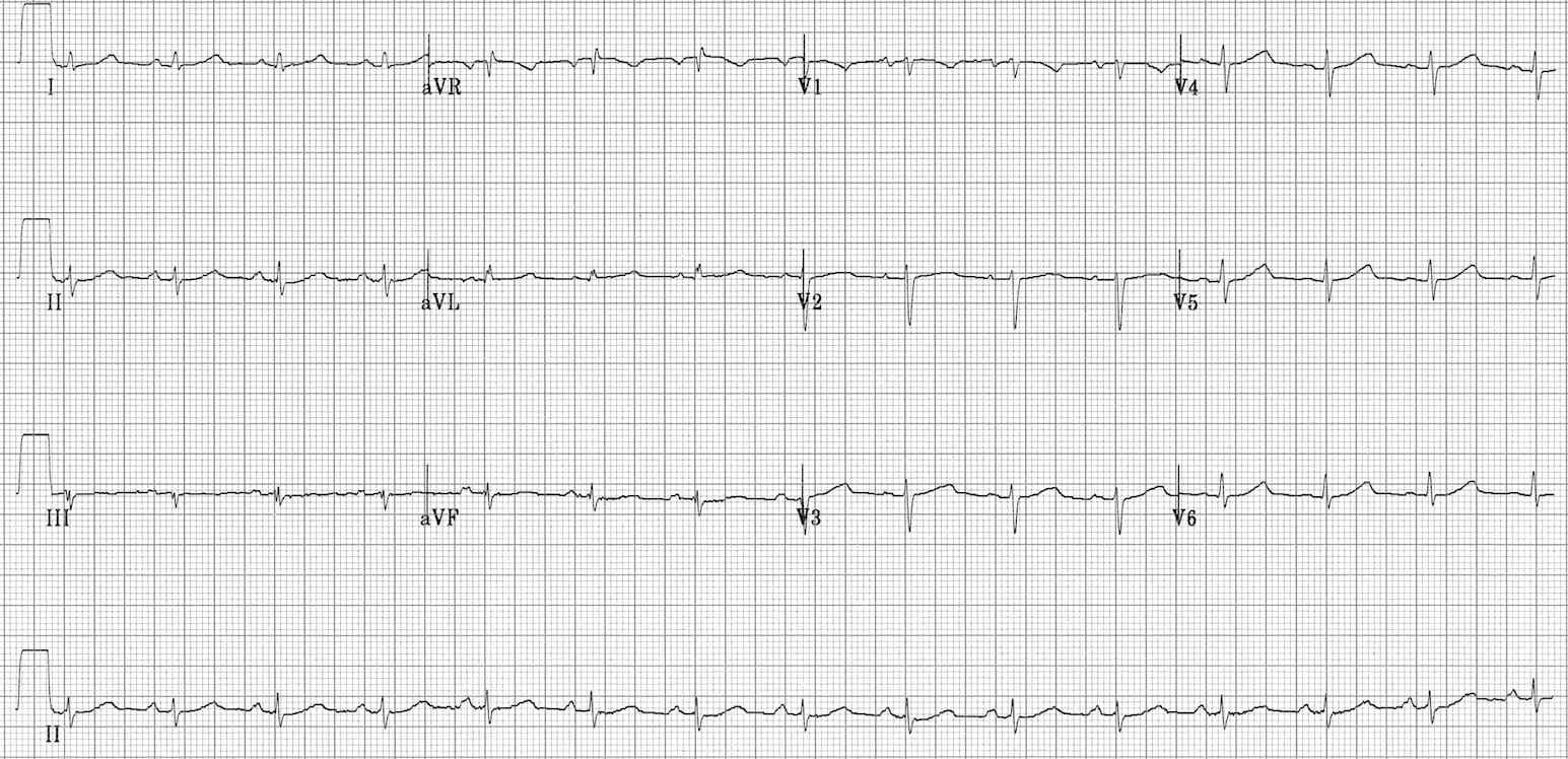 Fast-Slow-AVNRT resolved 3