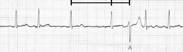 ECG Ashman aberrancy 5