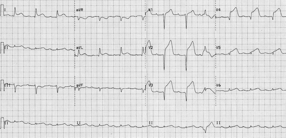 ECG Anterior STEMI evolving