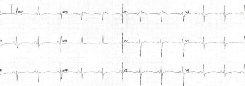 T-wave flattening in hypokalaemia