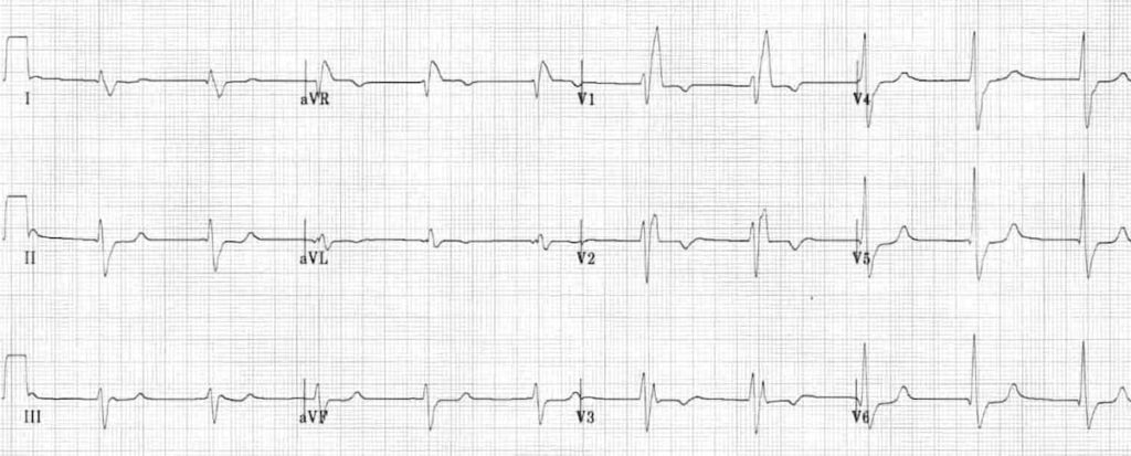 ECG Right Bundle Branch Block RBBB 6