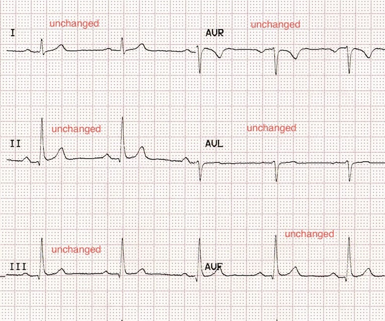 ECG Leads LL-RL reversal