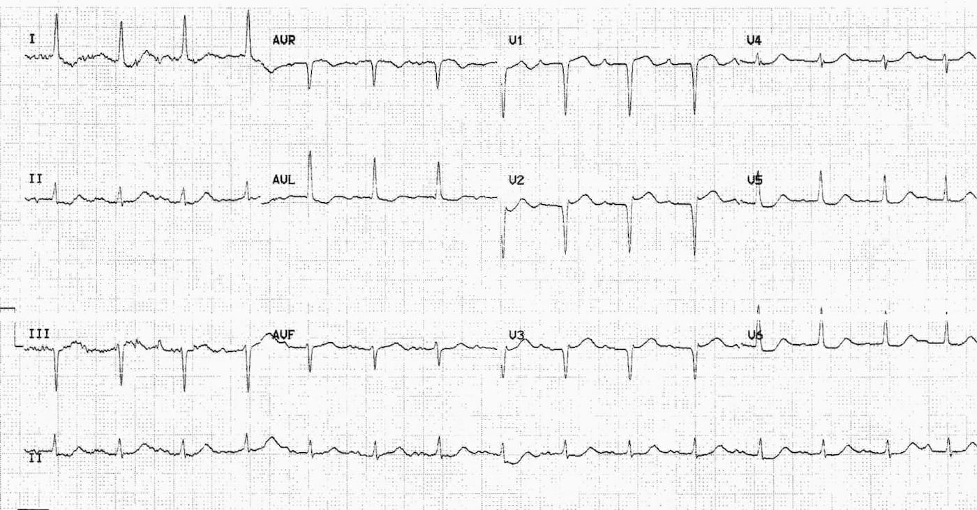 ECG 075b LITFL Top 100