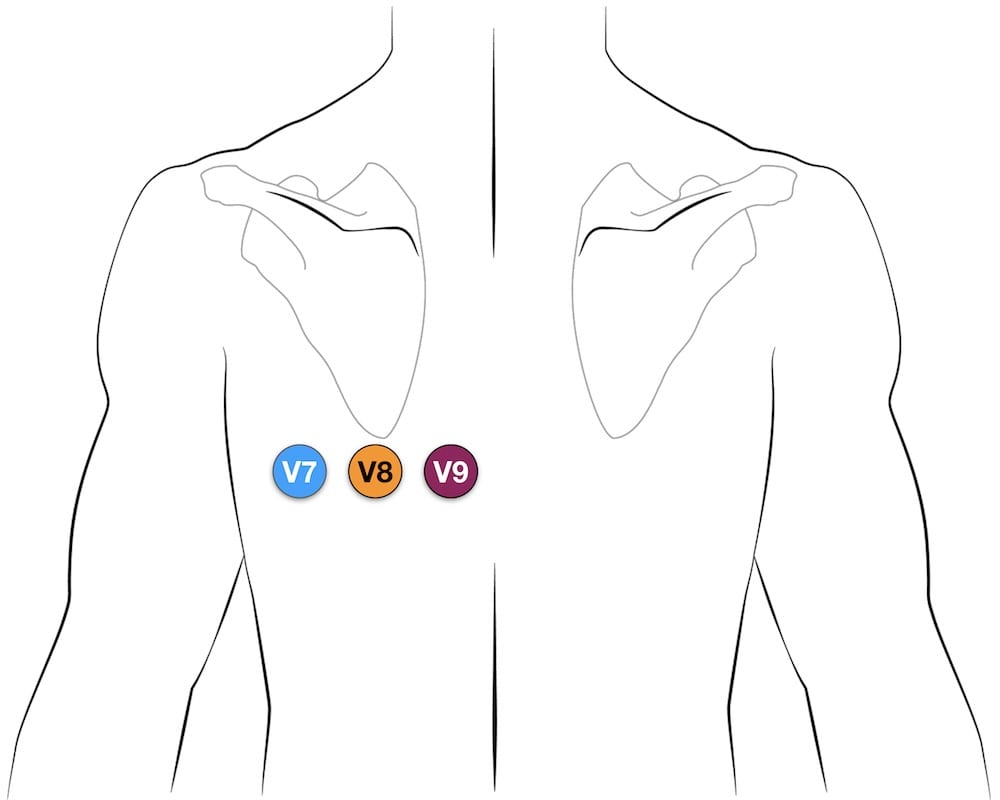 Posterior leads V7 V8 V9 ECG placement
