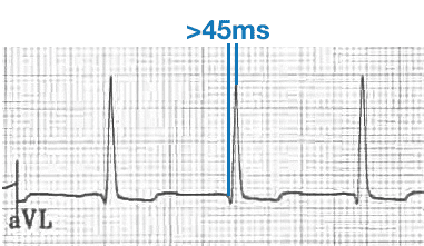 Prolonged R-wave peak time﻿ aVL
