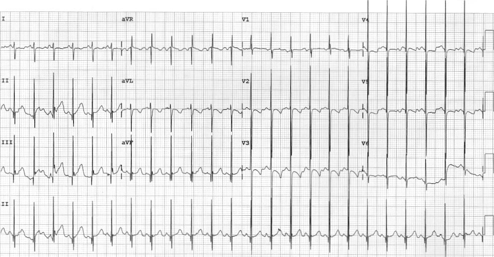 Katz-Wachtel phenomenon Biventricular hypertrophy in a child with VSD