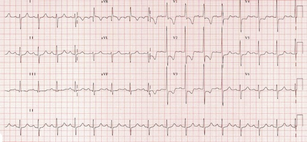 ECGH RVH Right ventricular hypertropy RV Strain