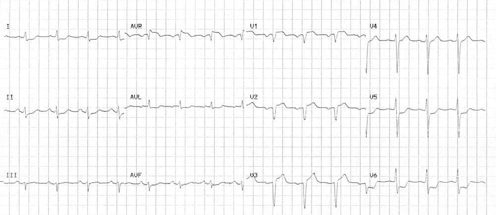 ECG LMCA or proximal LAD