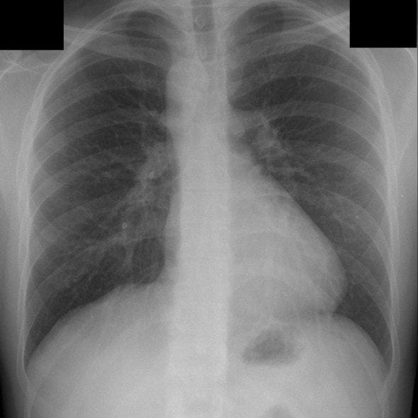CXR Right sided aortic arch