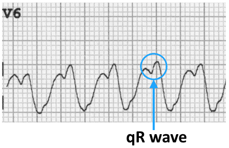 ECG VT LBBB V6 qR wave