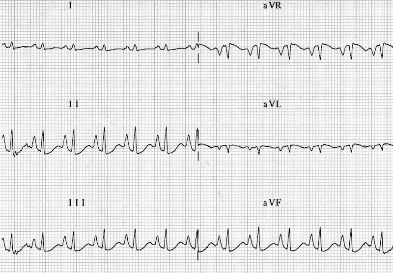 ECG Peaked P waves (P pulmonale) RAH