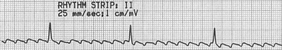 TOP 100 ECG QUIZ LITFL 018