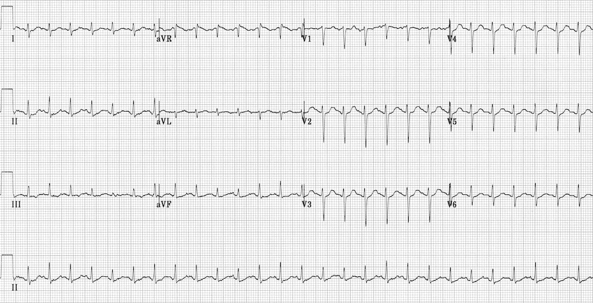 ECG Sinus Tachycardia