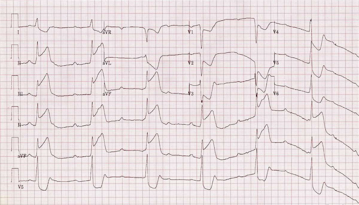 ECG Inferior AMI STEMI CHB Complete heart block