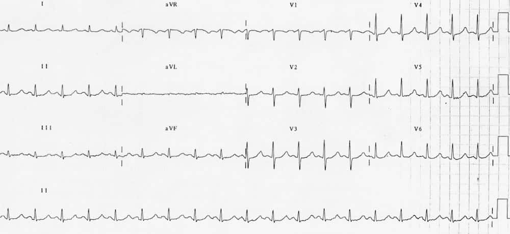 ECG Hypomagnesaemia prolonged QTc 510