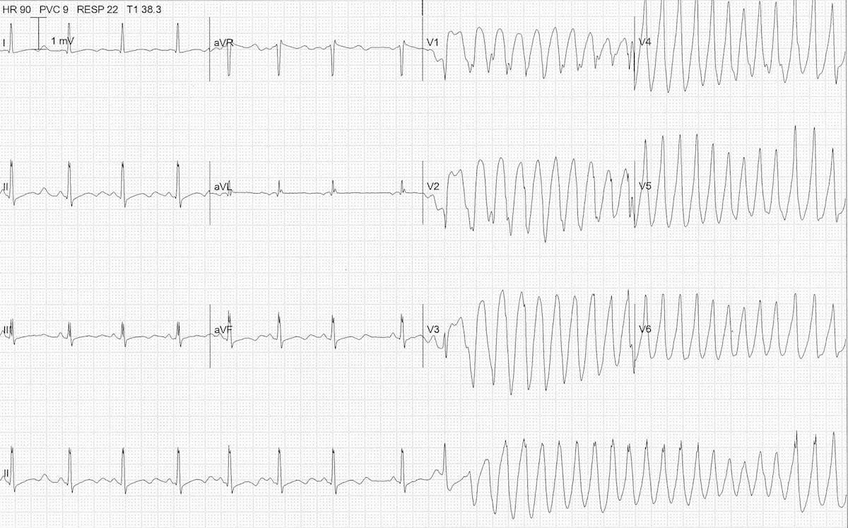 ECG severe hypokalemia serum potassium 2.0 TDP