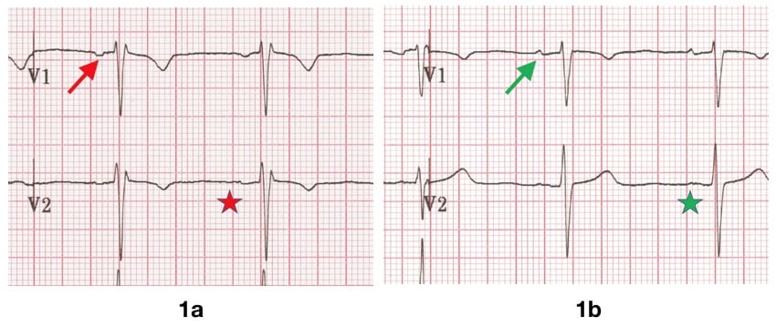 Figure 1 V1 V2 misplaced P wave (1a) and resolution (1b)