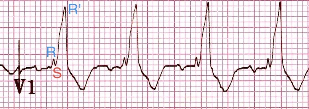 ECG Typical RSR' pattern of RBBB