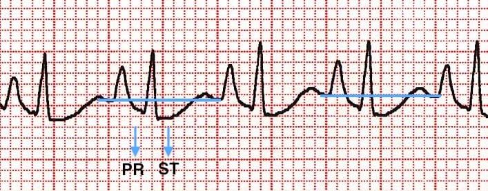 Sagging-PR-and-ST-in-COPD