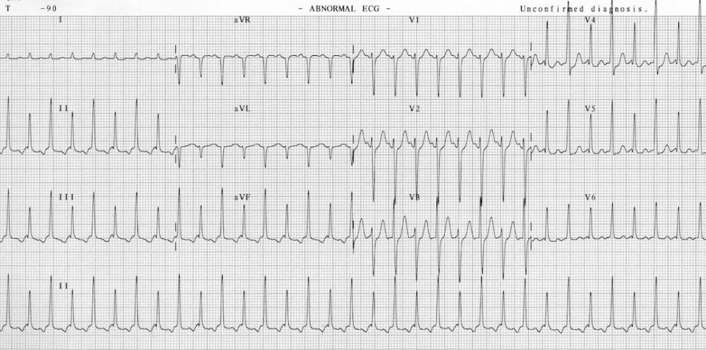 TOP 100 ECG QUIZ LITFL 071