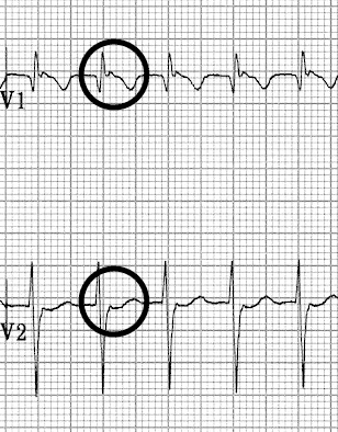 Slow-Fast (Typical) AVNRT Pseudo R’ waves in V1-2
