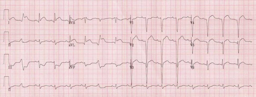 ECG High Lateral STEMI 2