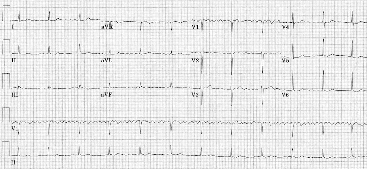 Regularised AF digoxin toxicity